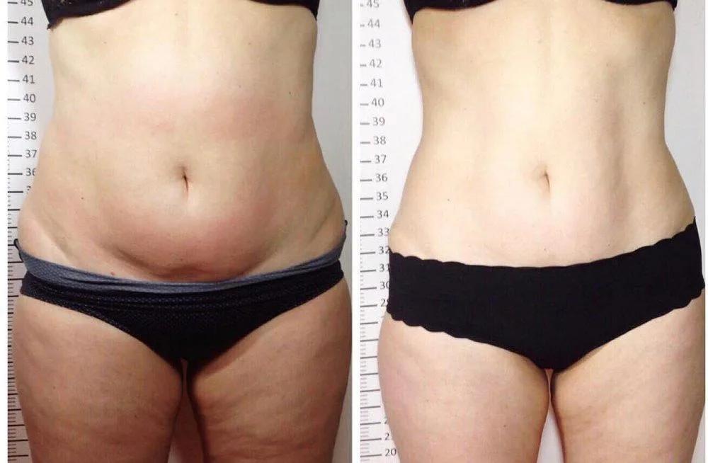 Umfangreduktion Bauch